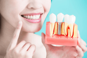 https://mymintdental.in/blog/dental-implant/the-last-dental-implant-guide-youll-ever-need/
