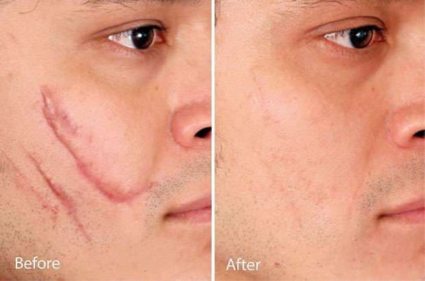 Scar Reduction in Dubai | Smooth, Healthy-Looking Skin