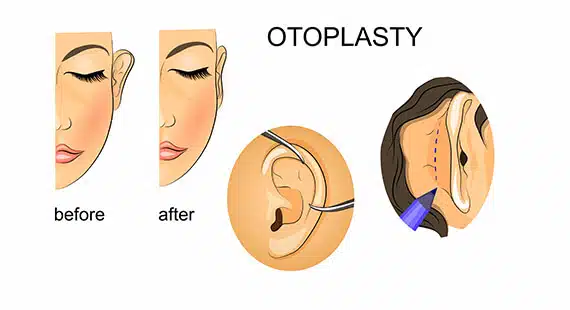 Otoplasty Surgery Cost in Delhi - Dr Rajat Gupta