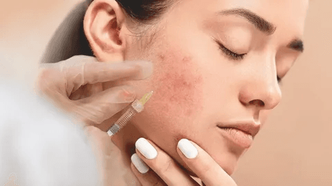 Clear Your Skin with Pimples Treatment in Dubai