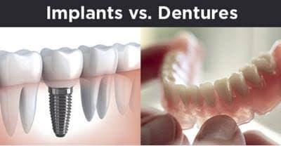 Dental Implants vs Dentures: Which Is Better for Missing Teeth?
