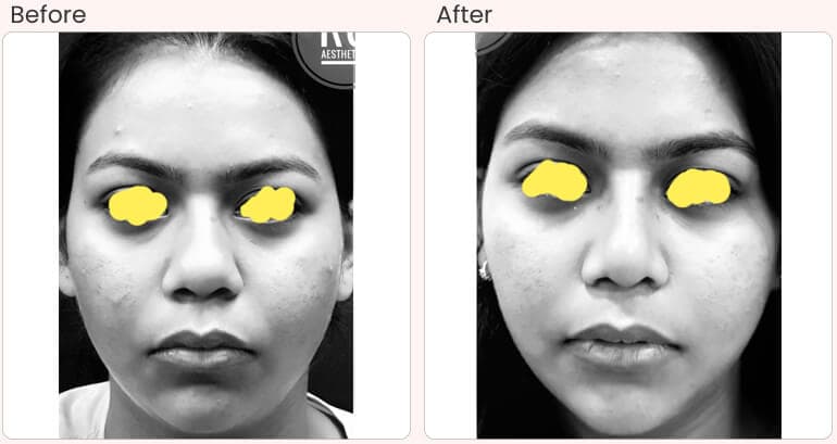 Buccal Pad Fat Removal Surgery in Delhi - Dr Rajat Gupta