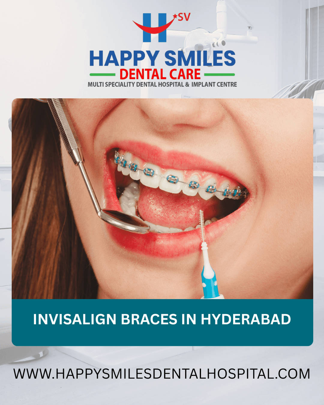 Invisalign Braces in Vanasthalipuram