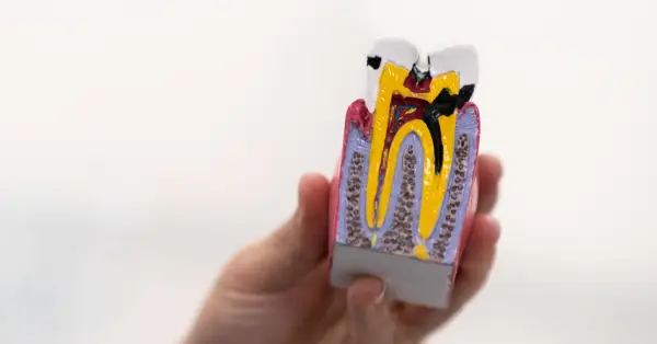 Root Canal Myths vs. Facts in Grand Prairie
