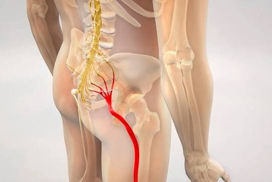 Exercises That May Support Sciatica Treatment and Recovery