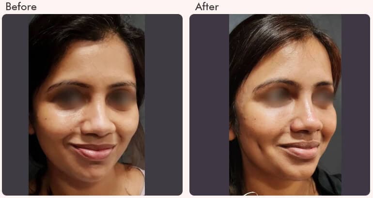 Dimple Creation Treatment in Delhi - Dr Rajat Gupta