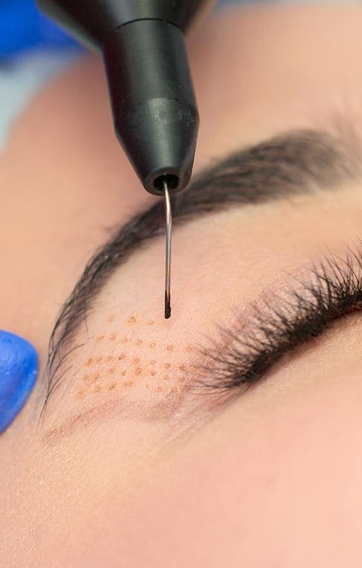 Plexr Plasma Eye Lift in Dubai | Tighten & Refresh Eyes