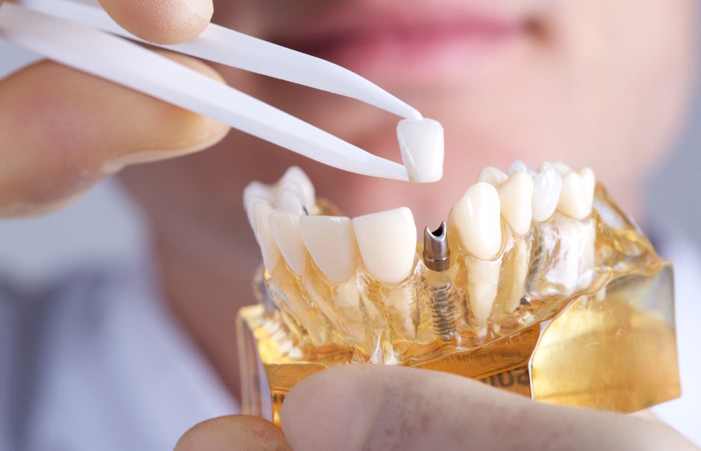 Are Dental Implants Safe? Everything You Need to Know Before