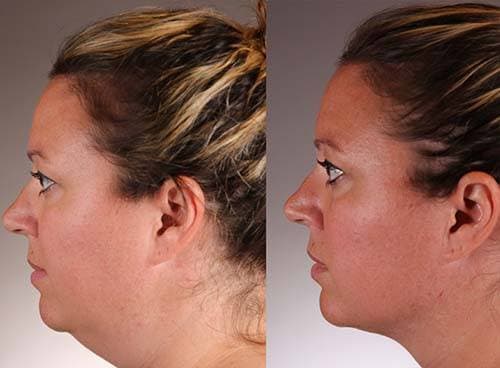 Addressing the Structural Toll of Postural Strain on the Lower Face