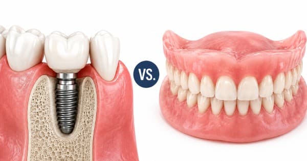 Implants or Dentures? Cathedral City Decision Guide