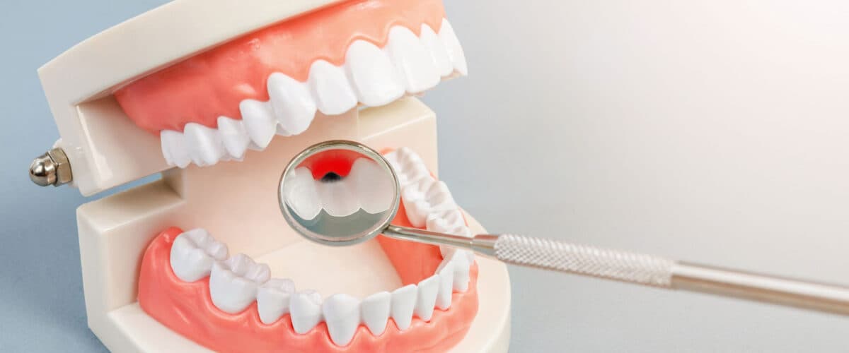 Dental Braces in Converse, TX | Straighten Your Smile with Expert Orthodontic Care