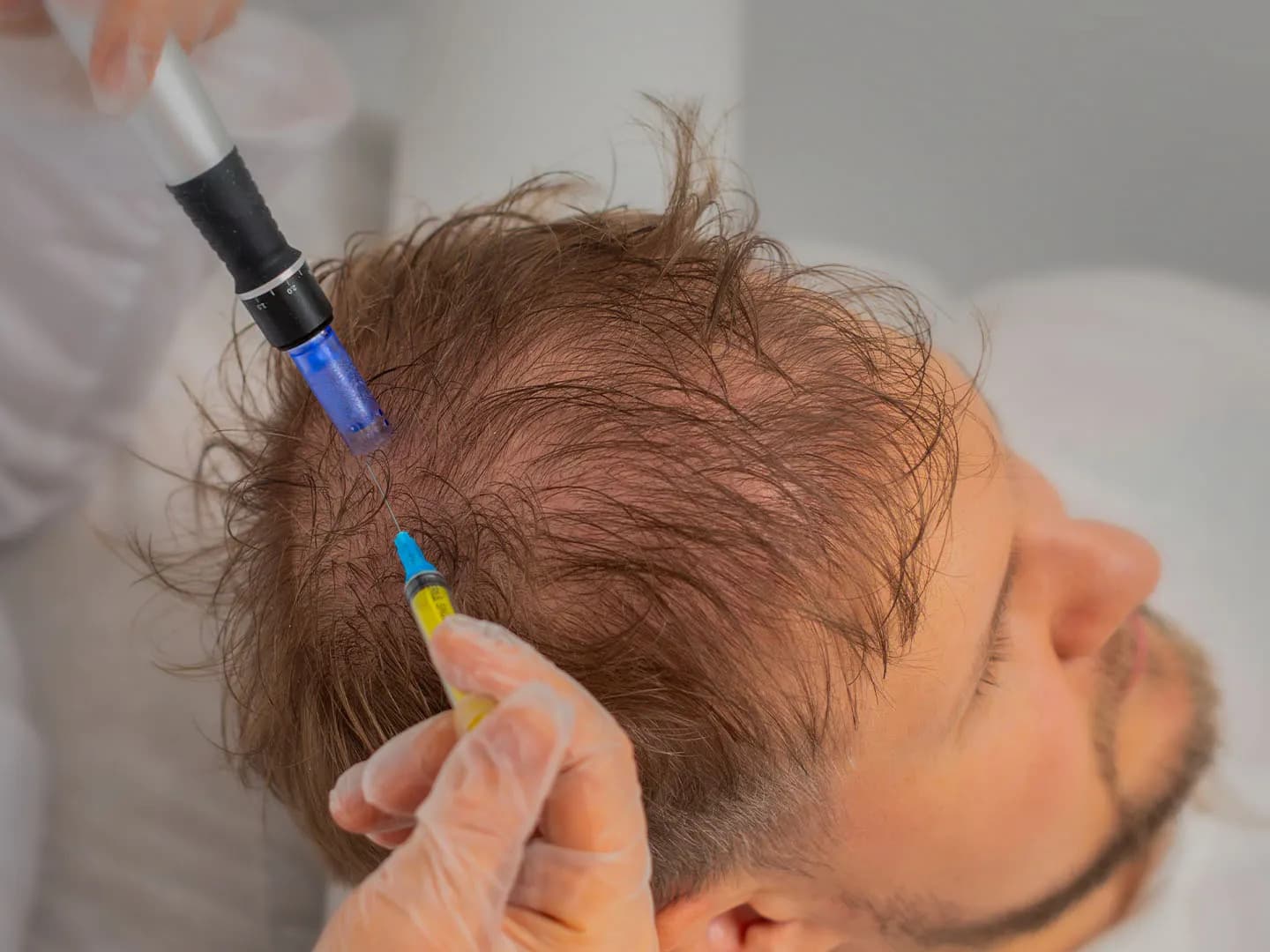 Hair Regrowth After PRP Failure: Explore Advanced Options
