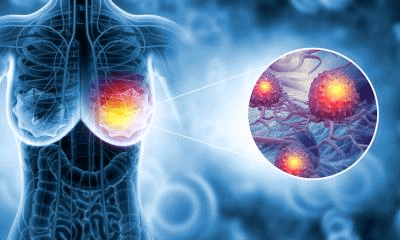 Is Stage 1 Breast Cancer Curable
