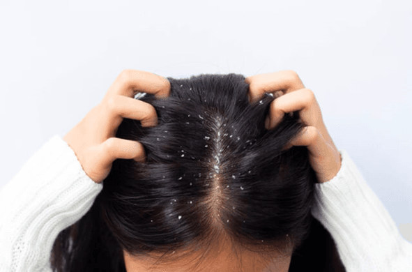 DANDRUFF TREATMENTS DANDRUFF CAUSES, PREVENTION & TREATMENT