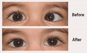 Best Squint Eye Treatment in Delhi