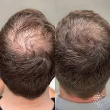 PRP Therapy for Hair Loss Benefits Procedure and Results