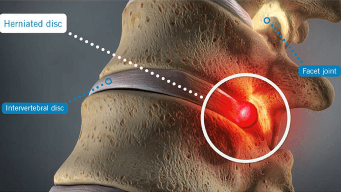 Herniated Disc Treatment by Top neurosurgeon in Delhi