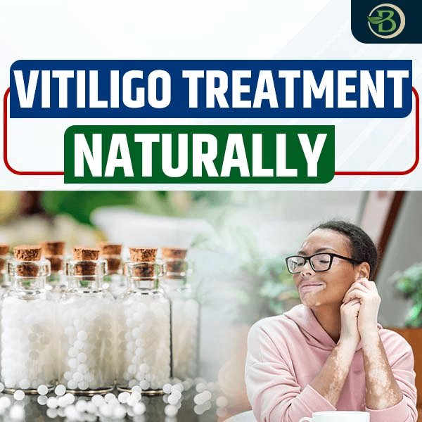 Vitiligo Treatment Naturally: Alternative Medication Approach to Treat Vitiligo Naturally