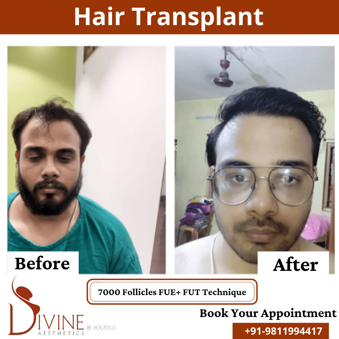 Hair Transplant Cost in Delhi: FUE VS FUT Hair Transplants