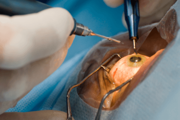 What is phacoemulsification cataract eye surgery?