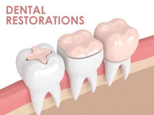Different Kinds of Dental Restorations