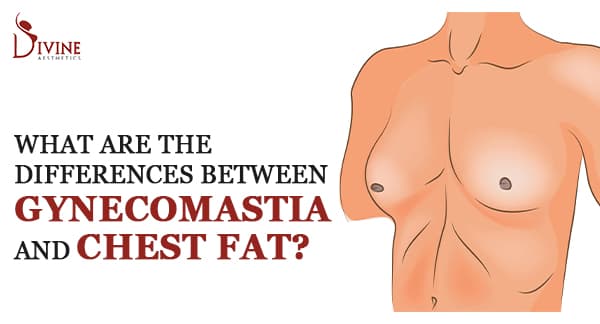 Differences Between Gynecomastia and Chest Fat?