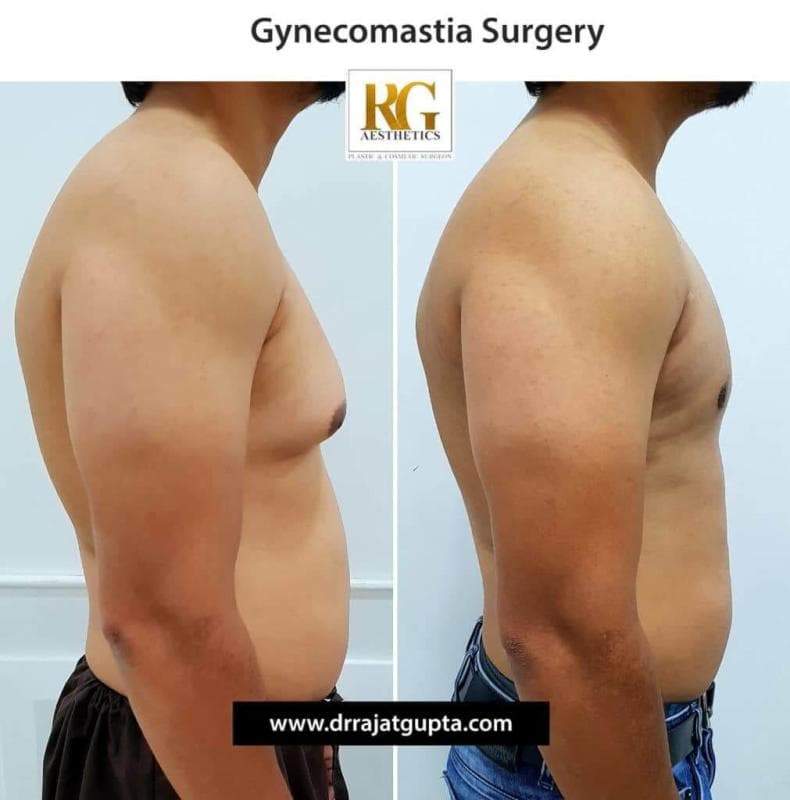 Gynecomastia Before and After: What Results Really Look Like