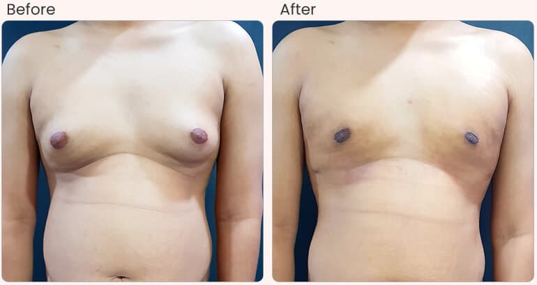 Gynecomastia Surgery in Delhi - Dr Rajat Gupta