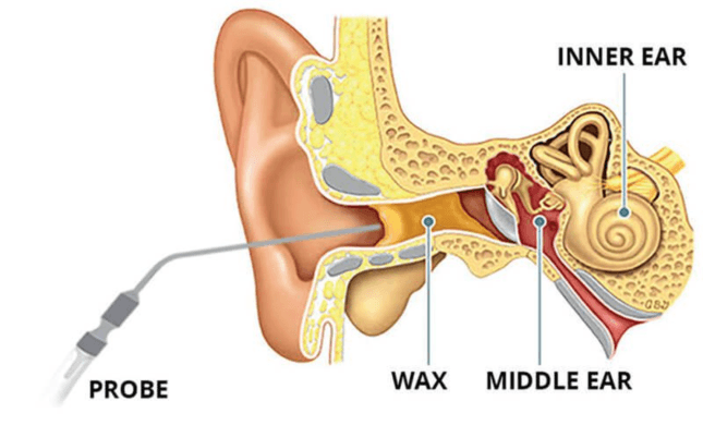Is Microsuction Ear Wax Removal Safe? Debunking Common Myths And Misconceptions