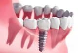 Implant Dentures Albany