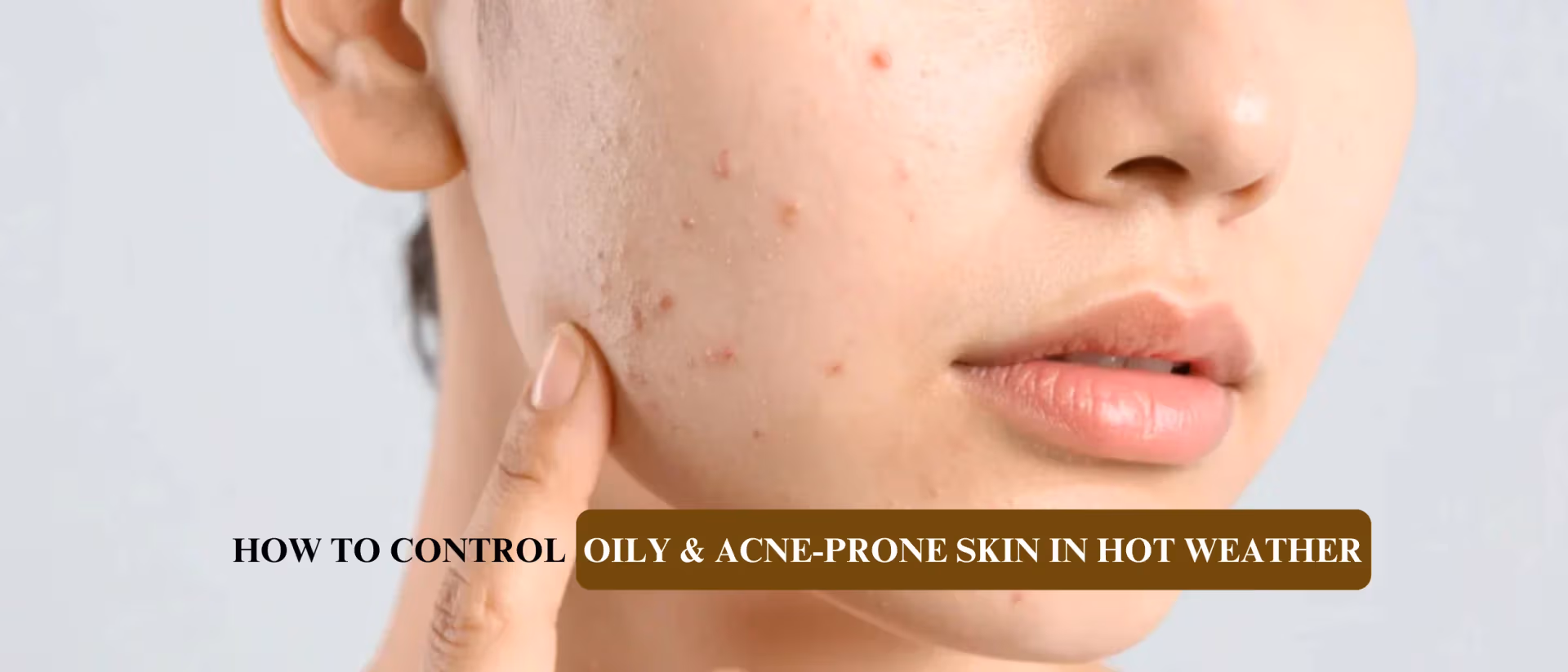 How to Control Oily & Acne-Prone Skin in Hot Weather