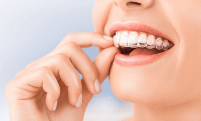 How Invisalign Clear Aligners Can Transform Your Smile: A Comprehensive Guide to the Treatment Proce