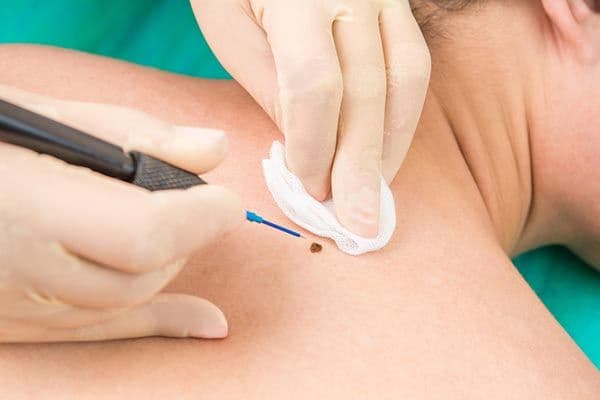 Mole Removal in Dubai | Clear Skin Starts Here