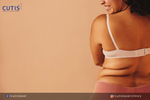How to Get Rid of Bra Fat Bulges without Surgery