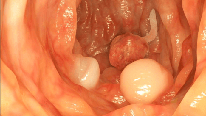 Uterine Polyps: Causes, Symptoms & Treatment