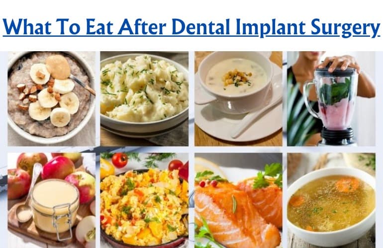 What to Eat After Dental Implant Surgery