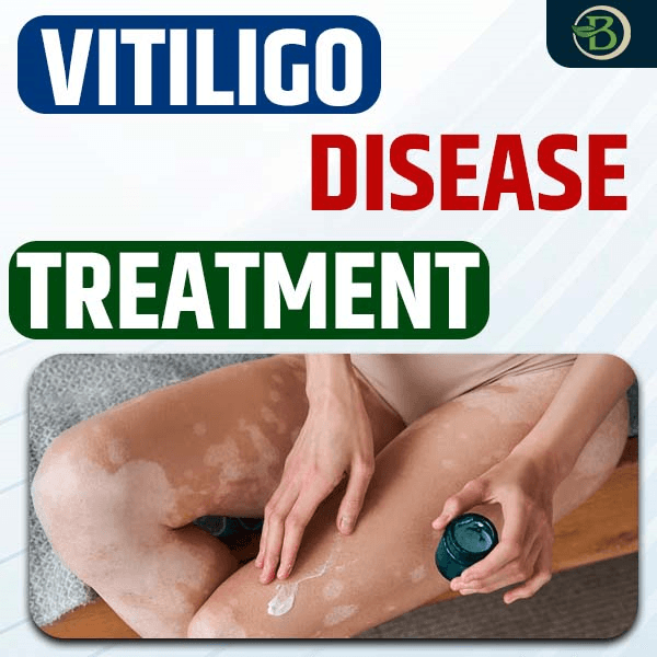 Best Treatment for vitiligo: Exploring Effective Treatments for Vitiligo At Bharat Homeopathy