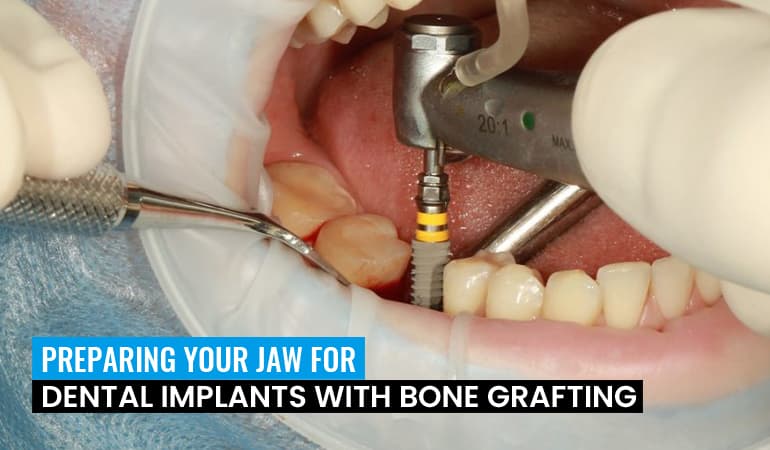 Preparing Your Jaw for Dental Implants with Bone Grafting