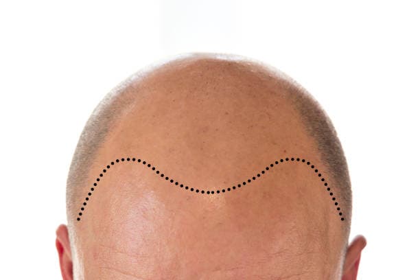 Hair Transplantation for Improving Hairline Appearance