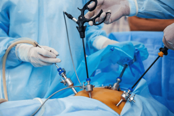 Advancing Women’s Health: Unveiling the Benefits of Laparoscopic Surgery in Gynaecology