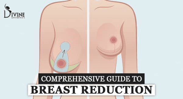 Breast Reduction Surgery Guide