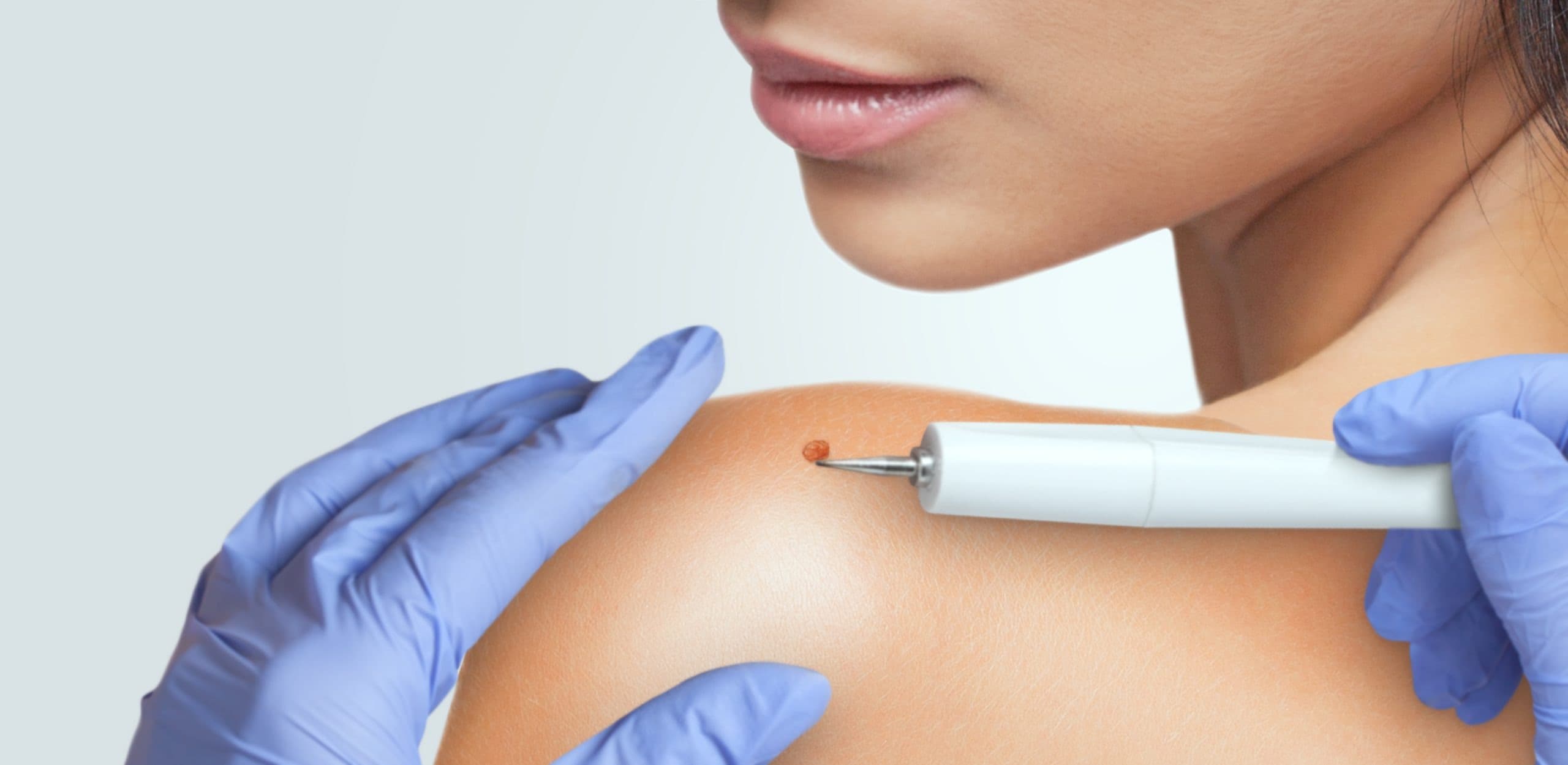 How Successful Is Skin Tag Removal in Dubai
