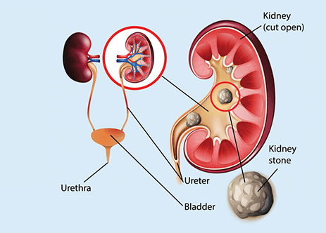 The Ultimate Guide To Kidney Stone Treatment in Pune: Dr. Abhijit Gokhale's Expertise