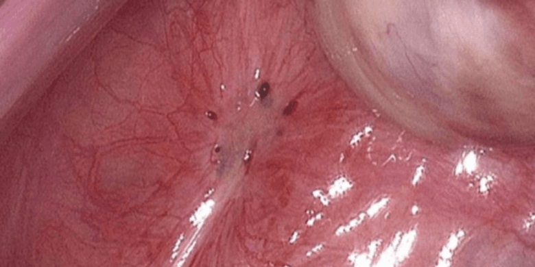 Understanding Endometriosis Recurrence Post-Hysterectomy