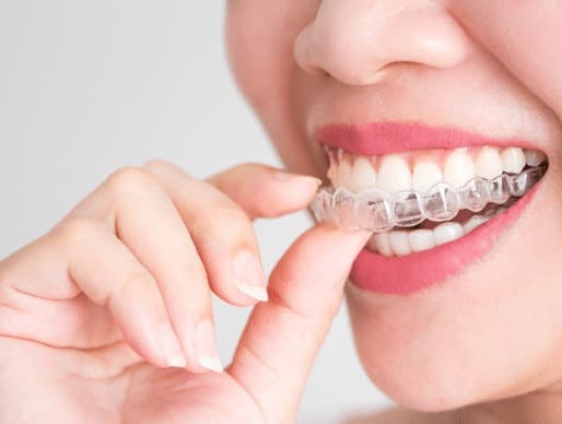 Invisalign in London, Ontario – Straighten Your Smile