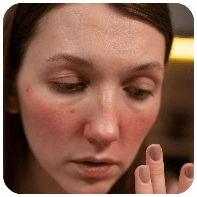 Demystifying Lupus: A Comprehensive Guide to the Types of Lupus
