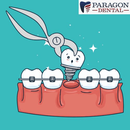 Wisdom Teeth Removal: What to Expect and How to Ensure a Smooth Recovery