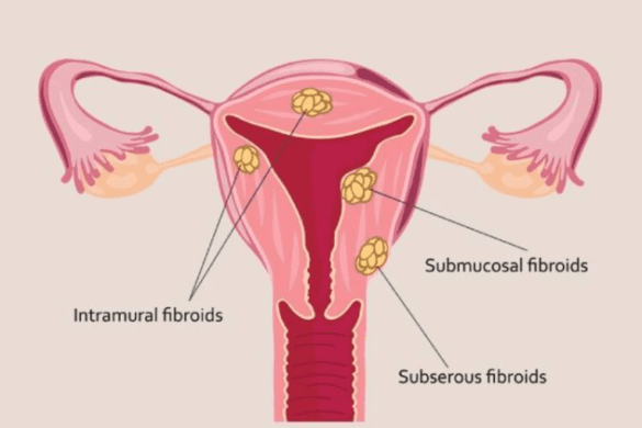 Uterine Fibroids