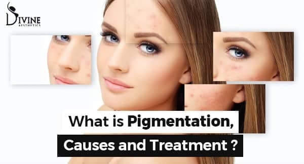 Pigmentation Causes Best Treatment at Delhi