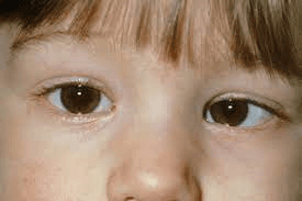 Non Surgical Solutions for Squint Eye Treatment